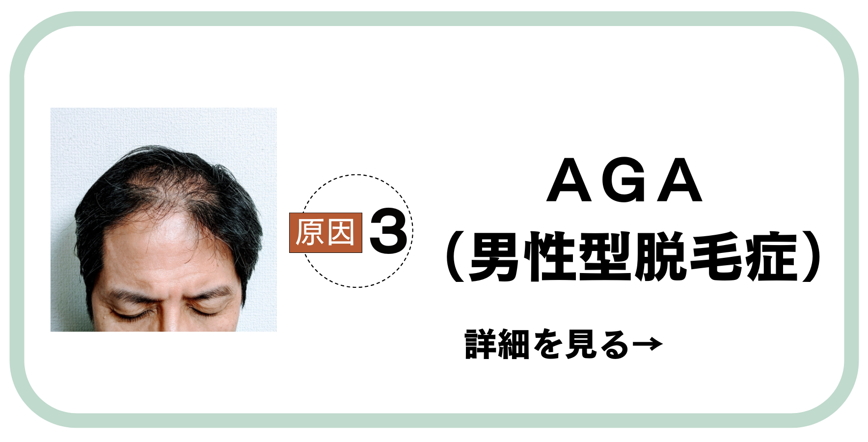 原因3AGA（男性型脱毛症）
男性薄毛の原因ワースト1
薬での治療はカラダに負担が