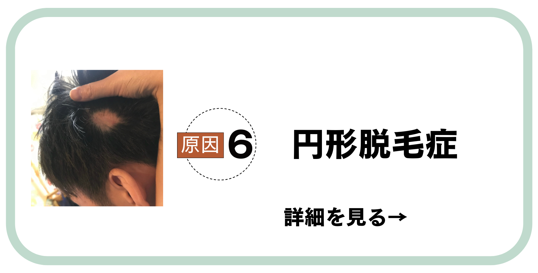 原因6円形脱毛症
カラダのサイン見逃さないで
心とカラダを整えよう